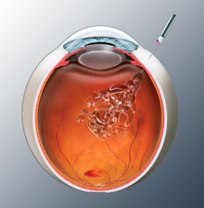 Intravenous Eye Injection | Imge of Eylea medicine eye injection