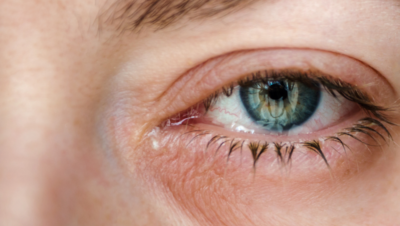 Which Type of Macular Degeneration Do I Have? | Image of Eye Disease