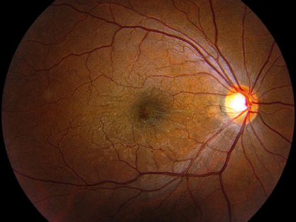 macular pucker pictures