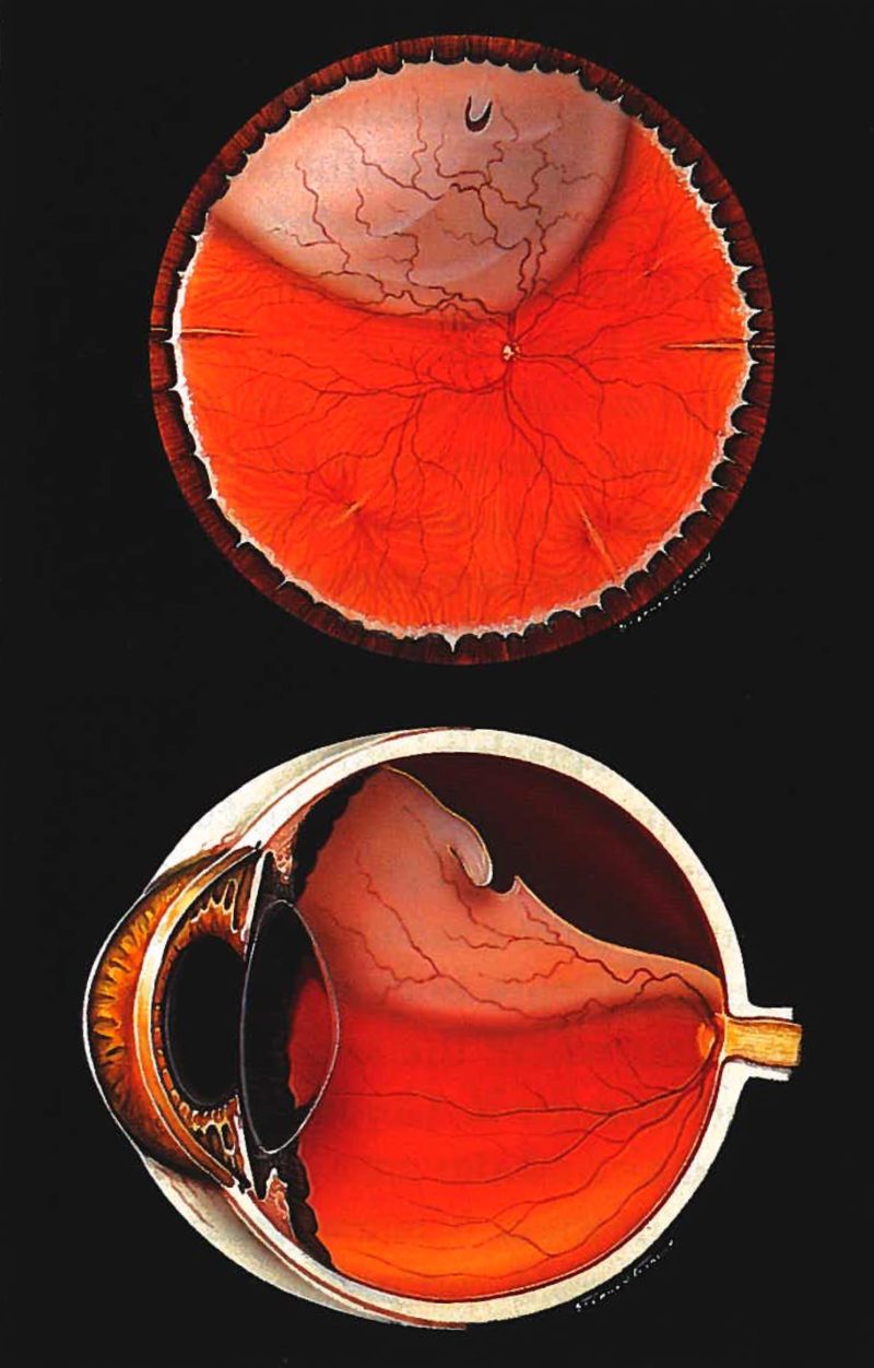 detached retina detached retina