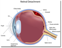 retina detachment surgery success rate retina detachment surgery success rate
