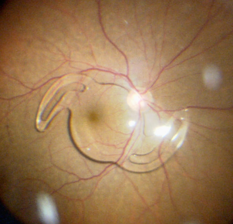 Dislocated Lens Implants Sarasota & Manatee County, FL