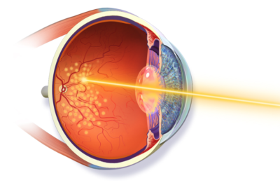 Retinal Laser