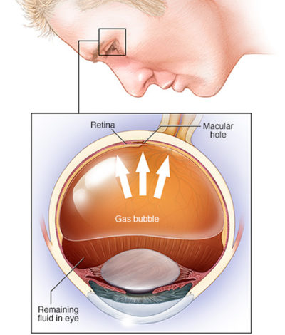 retinal detachment surgery pneumatic retinopexy