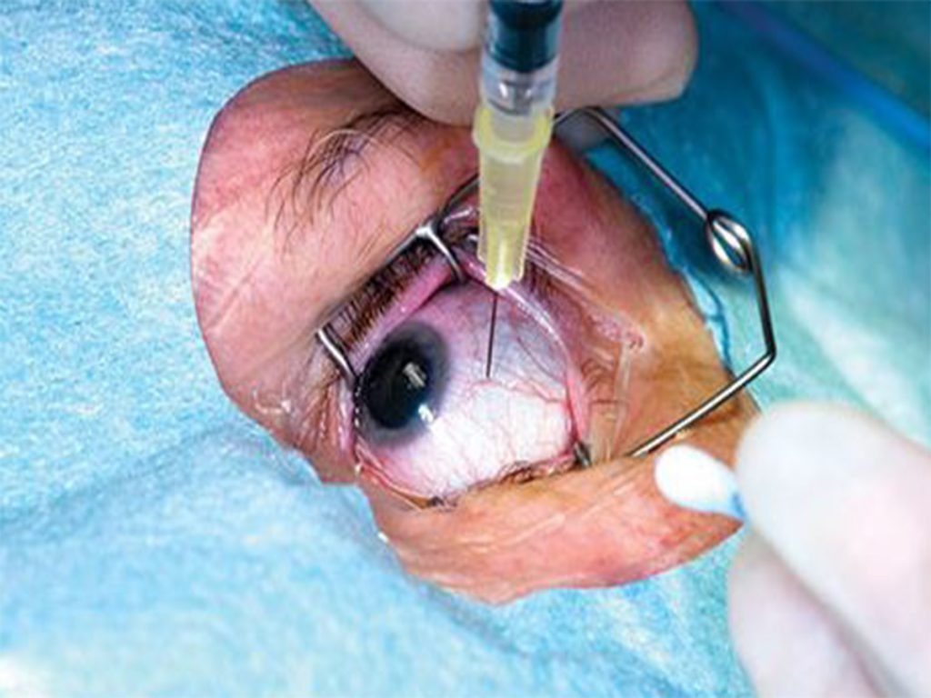 The Miracle of Eye Injections | Patient Recieving Injection in the Eye