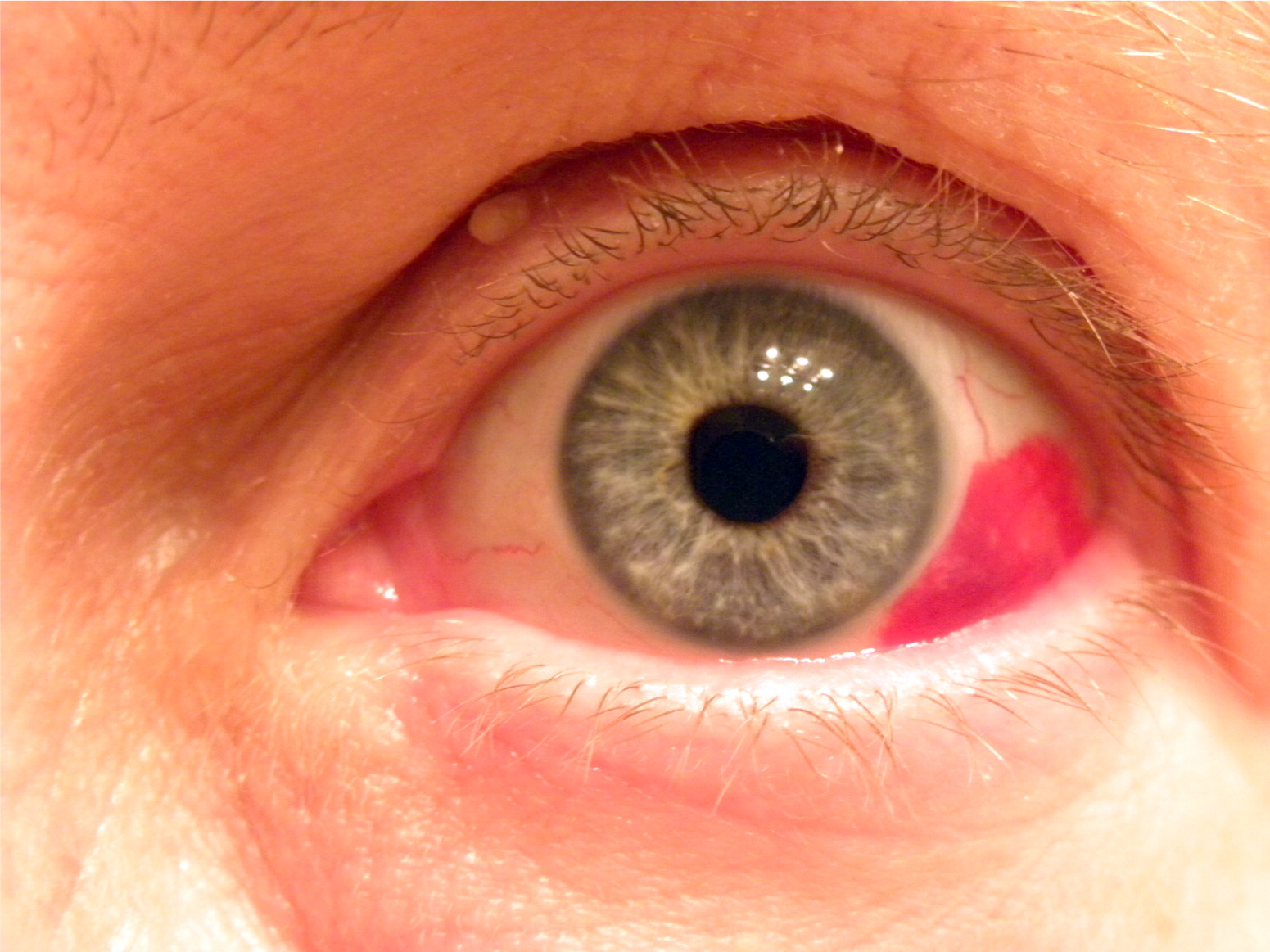 Problems of Frequent Eye Injections | The Stress of Frequent Visits Problems of Frequent Eye Injections | Image of Damaged Eye from Injections