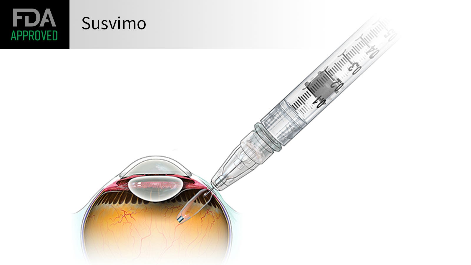 Susvimo Refill | FDA Approved Ocular Implant Susvimo Refill | Image of Eye Injection Refill