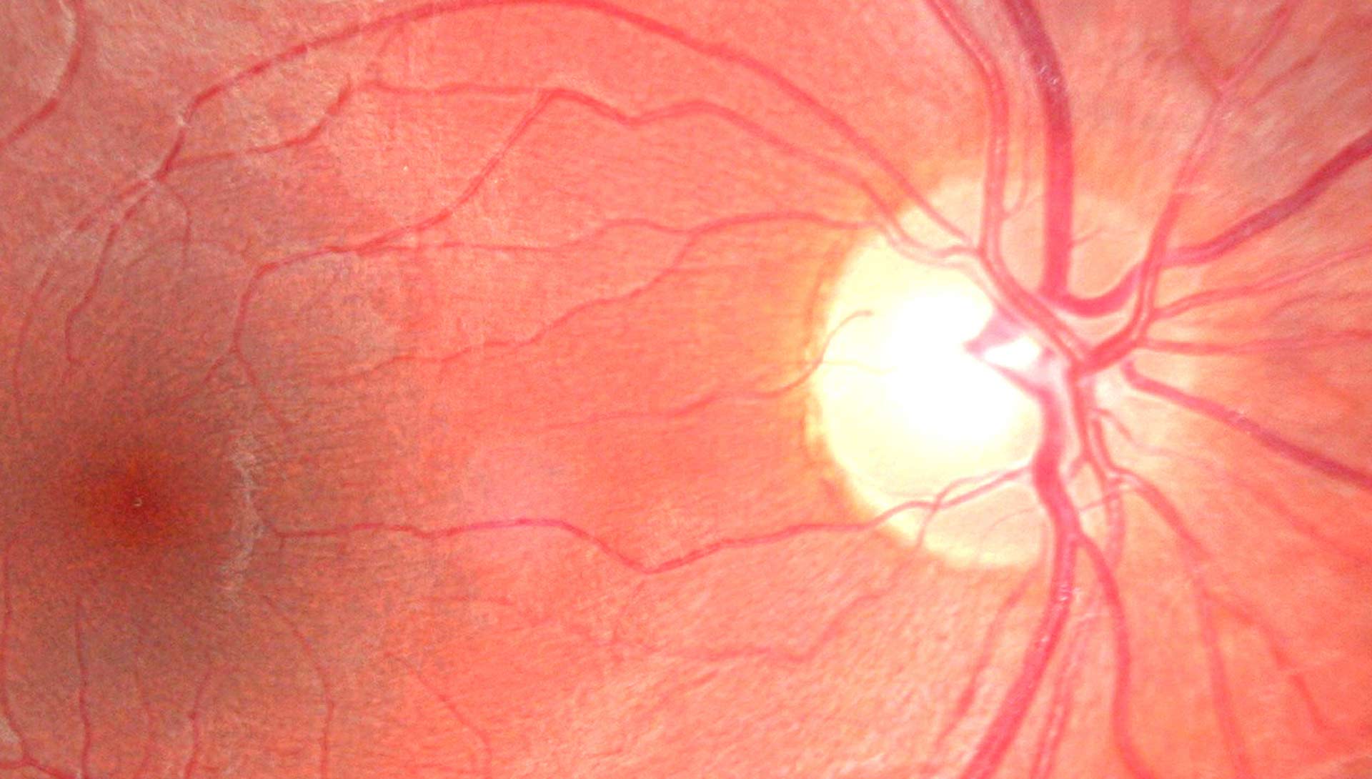 All About Cystoid Macular Edema | Image Zoomed In on Retina