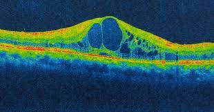 What is Cystoid Macular Edema? | Thermal Image of Eye Condition