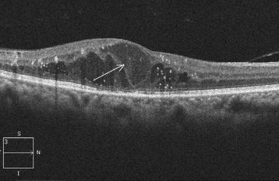 Diabetic Macular Edema | Close Up Image of Eye Condition