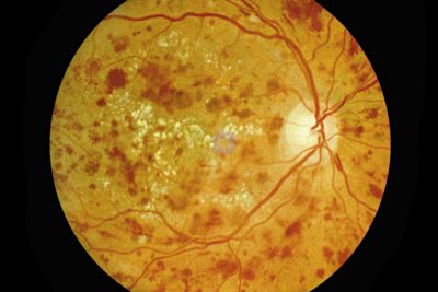 Non Proliferative Diabetic Retinopathy