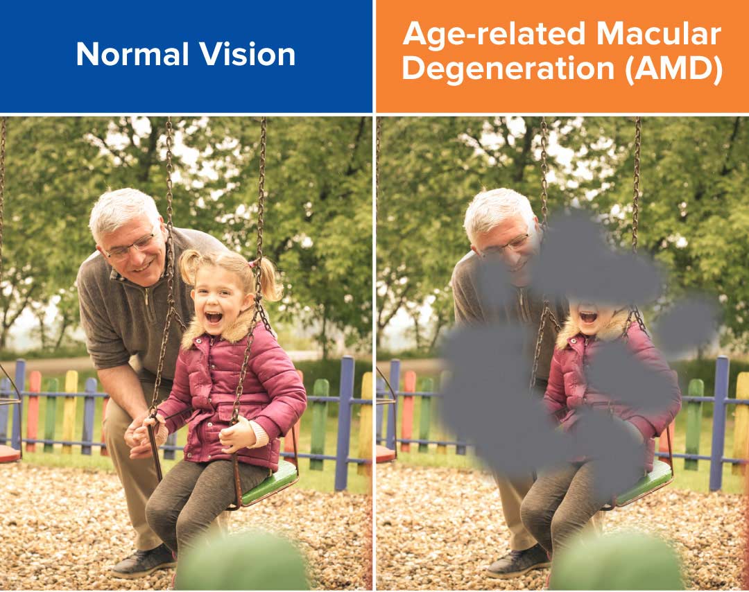Normal Vision Vs. Vision with Age Related Macular Degeneration
