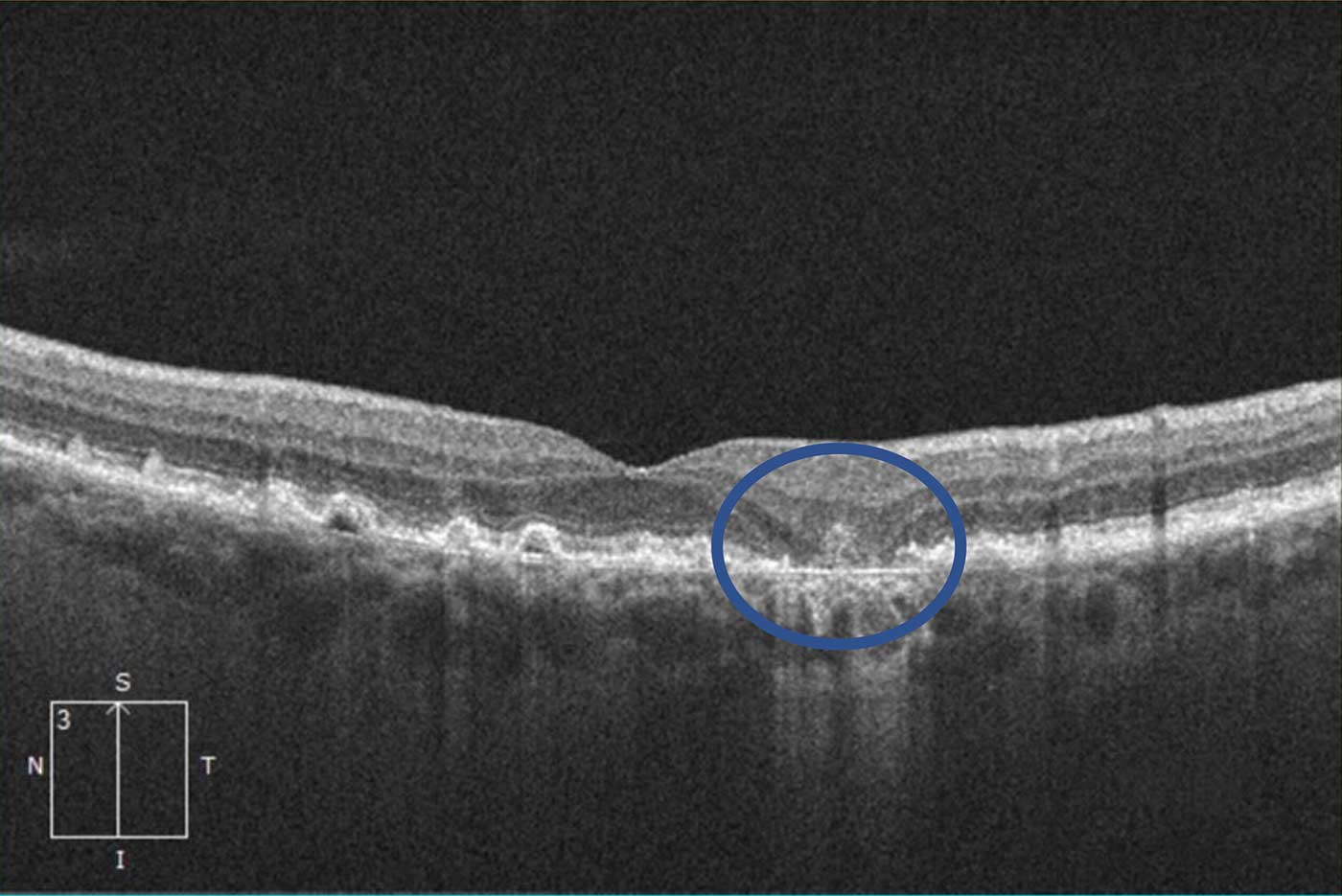 Retinal atrophy causing a blind spot near the central vision in Macular Degeneration.