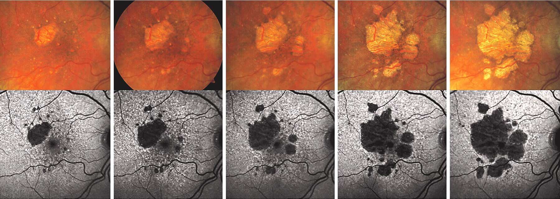 Progression of dry macular degeneration. With advanced dry macular degeneration, retinal atrophy leads to blind spots in the central vision that enlarge over time